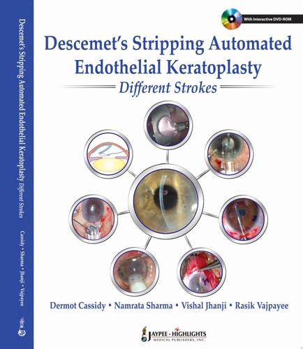 Descemet's Stripping Automated Endothelial Keratoplasty: Different Strokes