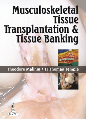 Musculoskeletal Tissue Transplantation and Tissue Banking