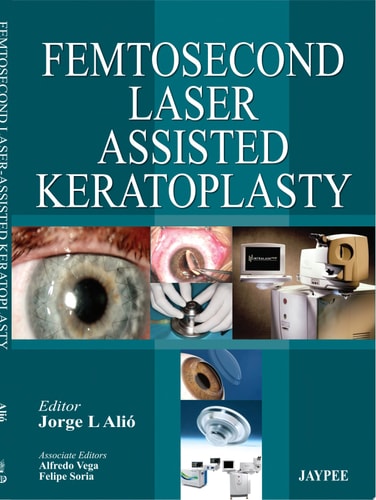 Femtosecond Laser Assisted Keratoplasty-zoom-1