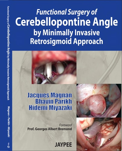 Functional Surgery of Cerebellopontine Angle by Minimally Invasive Retrosigmoid Approach