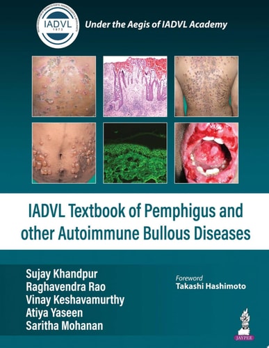 Textbook of Pemphigus and Other Autoimmune Bullous Diseases-zoom-1
