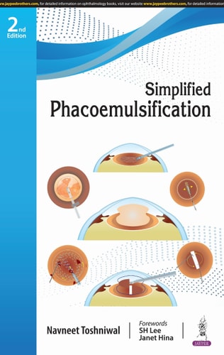 Simplified Phacoemulsification-1