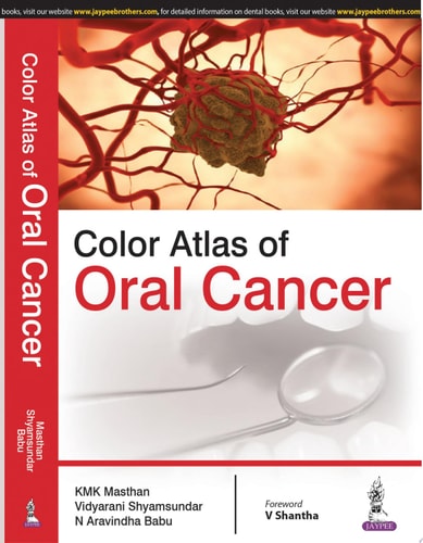 Color Atlas of Oral Cancer