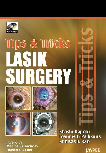 LASIK Surgery Tips and Tricks