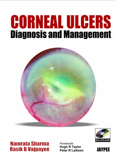 Corneal Ulcers Diagnosis and Management