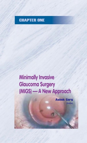 Step by Step Minimally Invasive Glaucoma Surgery with Dvd-rom by Garg