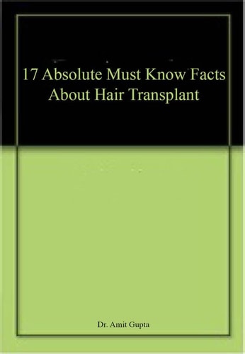 17 Absolute Must Know Facts About Hair Transplant