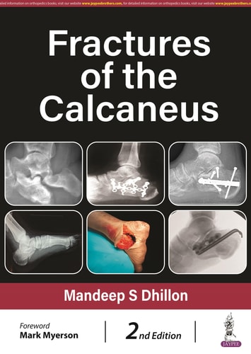 Fractures of the Calcaneus-zoom-1