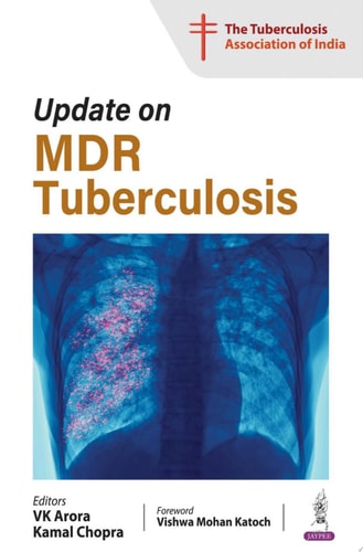 Update on MDR Tuberculosis