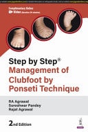 Step by Step: Management of Clubfoot by Ponseti Technique