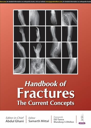Handbook of Fractures The Current Concepts
