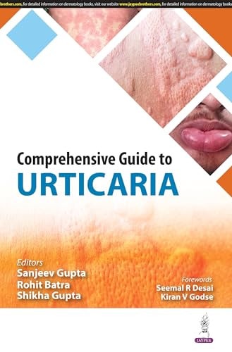 Comprehensive Guide to Urticaria