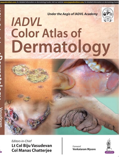 IADVL Color Atlas of Dermatology