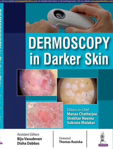 Dermoscopy in Darker Skin