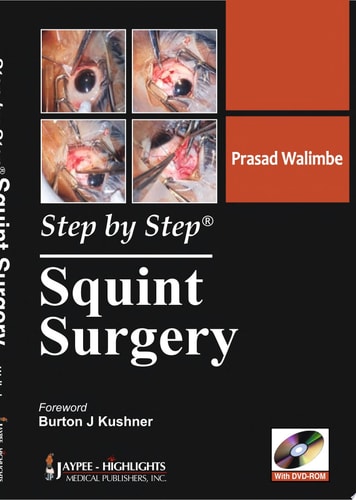 Step by Step® Squint Surgery