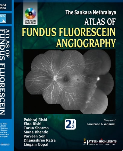 The Sankara Nethralaya Atlas of Fundus Fluorescein Angiography-1