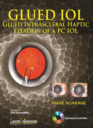 GLUED IOL Glued Intrascleral Haptic Fixation of a PC IOL-zoom-