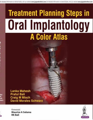 Treatment Planning Steps in Oral Implantology A Color Atlas-zoom-