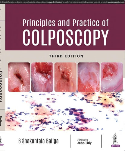 Principles and Practice of Colposcopy