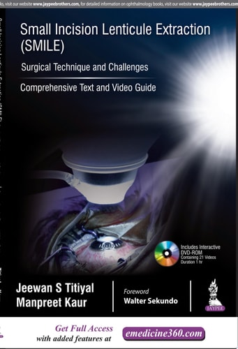 Small Incision Lenticule Extraction (SMILE): Surgical Technique and Challenges Comprehensive Text and Video Guide