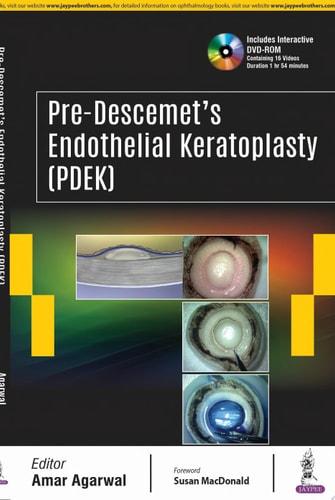 Pre-Descemet’s Endothelial Keratoplasty (PDEK)-zoom-