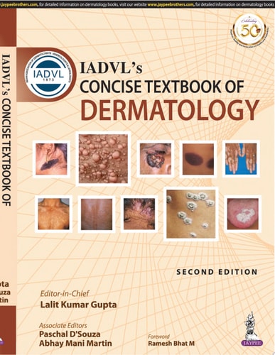 IADVL's Concise Textbook of Dermatology