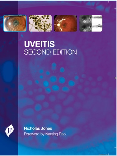 Uveitis-zoom-
