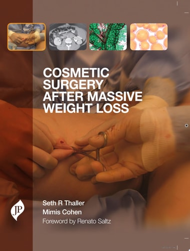 Cosmetic Surgery After Massive Weight Loss-zoom-1